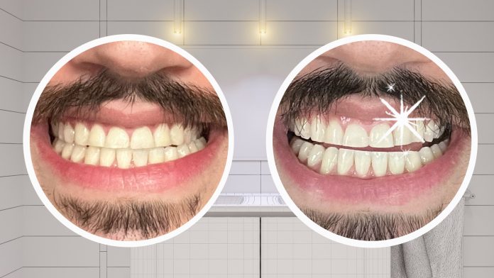 How Often Can You Use Teeth Whitening Strips: Maximize Results with Proper Usage